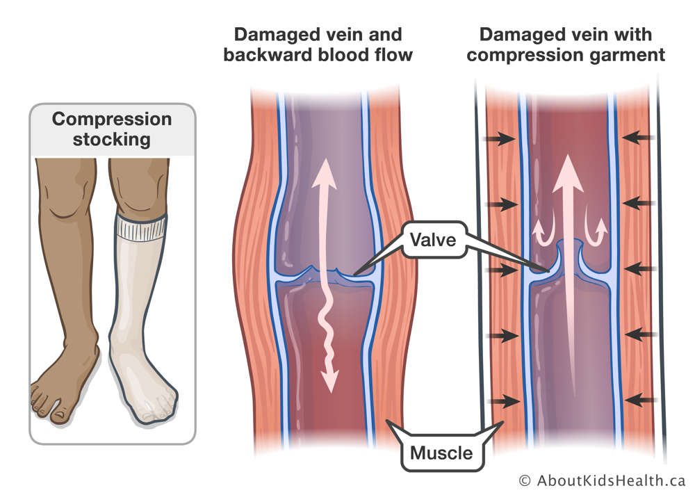 A damaged vein with backward blood flow and a damaged vein with compression garment allowing for better blood flow