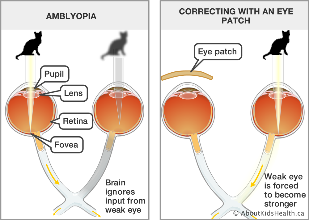 Comparison of vision with a lazy eye or amblyopia and vision corrected by an eye patch