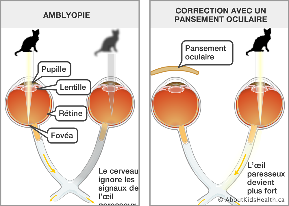 Comparaison de la vision avec un œil parresseux ou l'amblyopie et la vision corrigée par un pansement oculaire