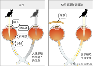 弱视视力与戴眼罩矫正后视力的比较