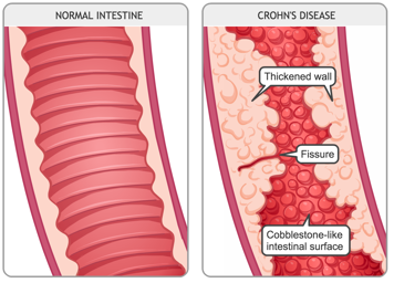 Close-up of a normal intestine and close-up of an intestine with Crohn’s disease