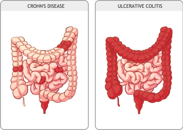 Intestines with Crohn’s disease and intestines with ulcerative colitis