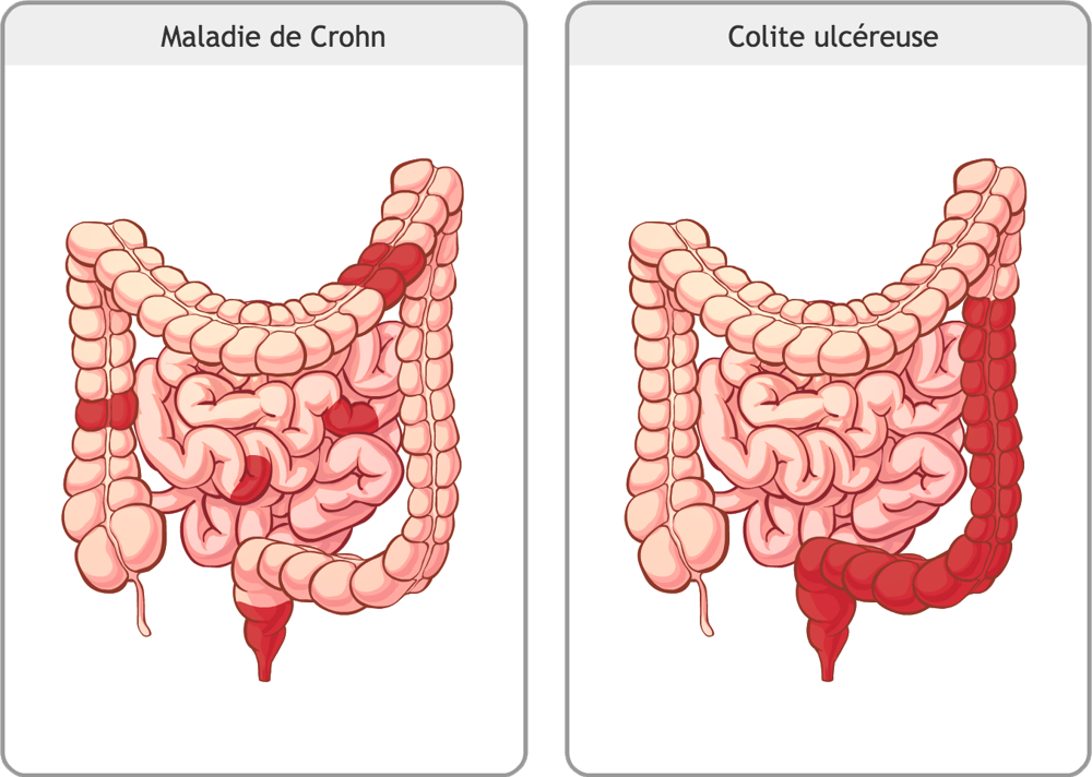 Intestins avec maladie de Crohn et intestins avec colite ulcéreuse