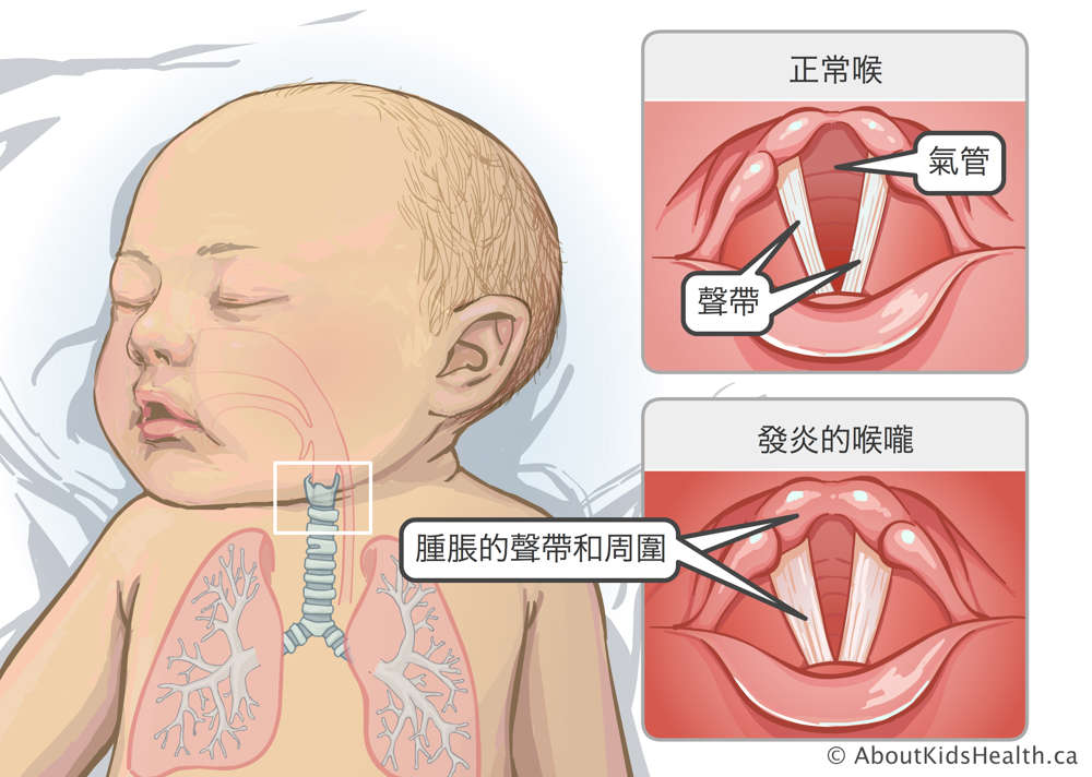 氣管和聲帶明晰可見的正常喉部，以及聲帶和周圍結構腫脹的發炎喉部