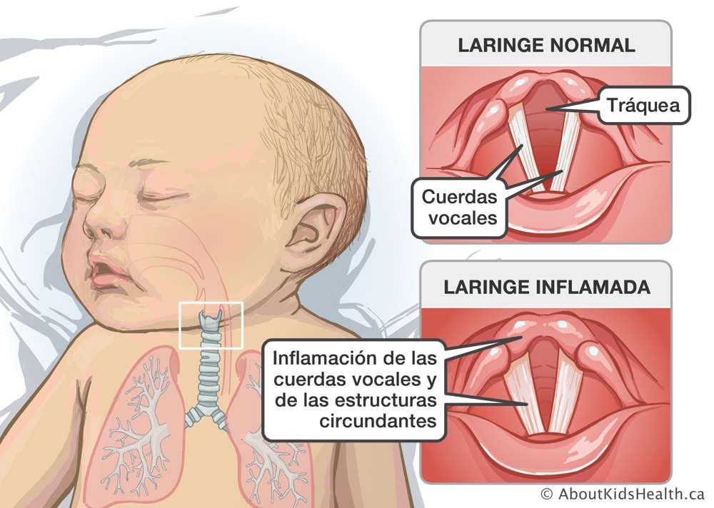 Laringe normal, tráquea y cuerdas vocales, y laringe inflamada con las cuerdas vocales y estructuras circundantes hinchadas