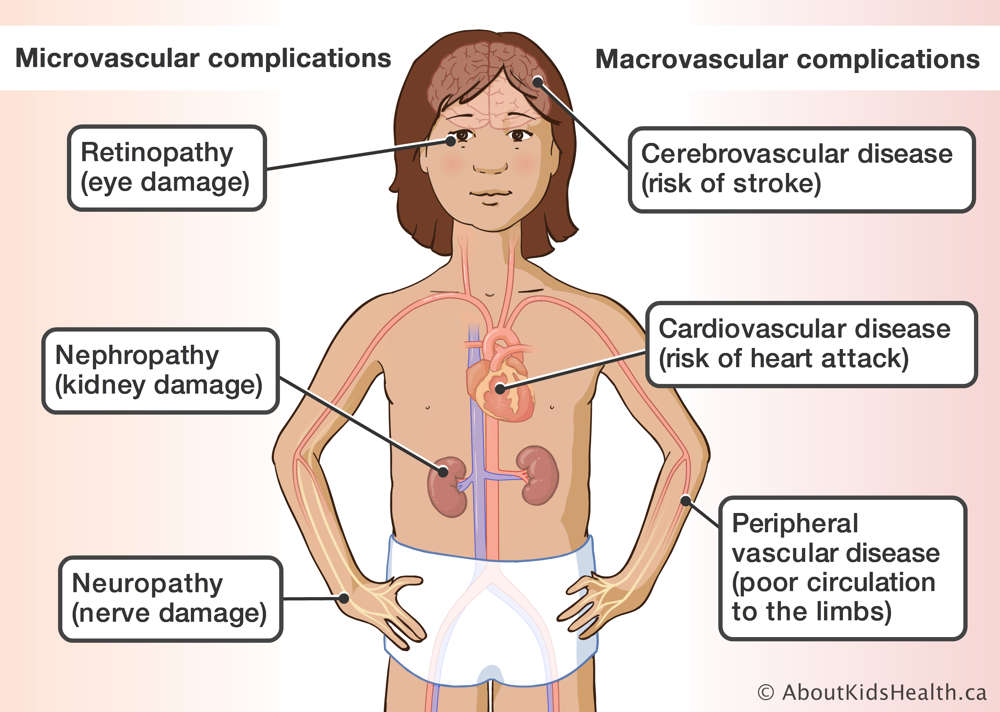 Body parts affected by microvascular and macrovascular diabetes complications highlighted 