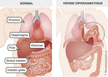 Bébé avec l’emplacement normal des organes, comparé à un bébé avec les organes abdominaux dans la cavité thoracique