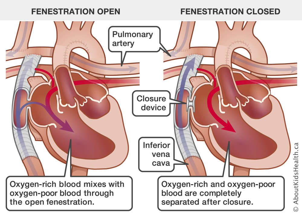 Blood flow through a heart with open fenestration compared to blood flow through a heart with a closure device