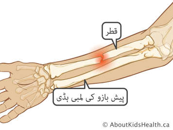 کلائی سے کہنی تک ٹوٹے ہوئے ہاتھ کا حلقہ