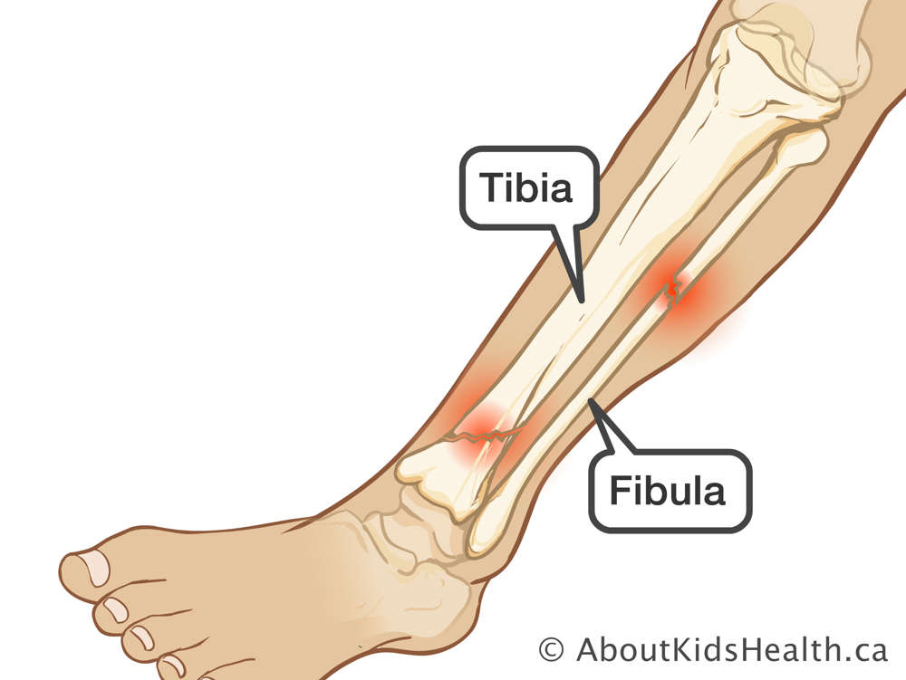 Lower leg with fractured tibia and fibula