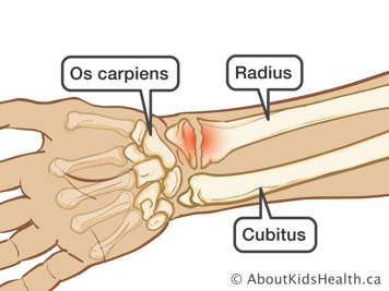 Poignet avec une fracture du radius