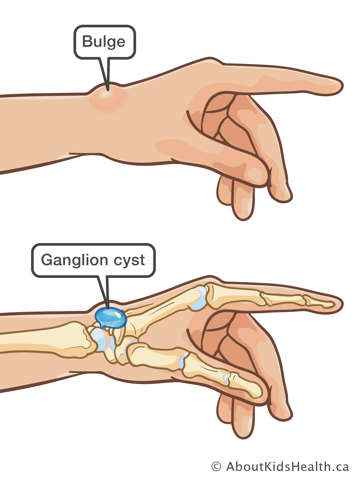 Bulge under the skin of the wrist and ganglion cyst shown under the skin