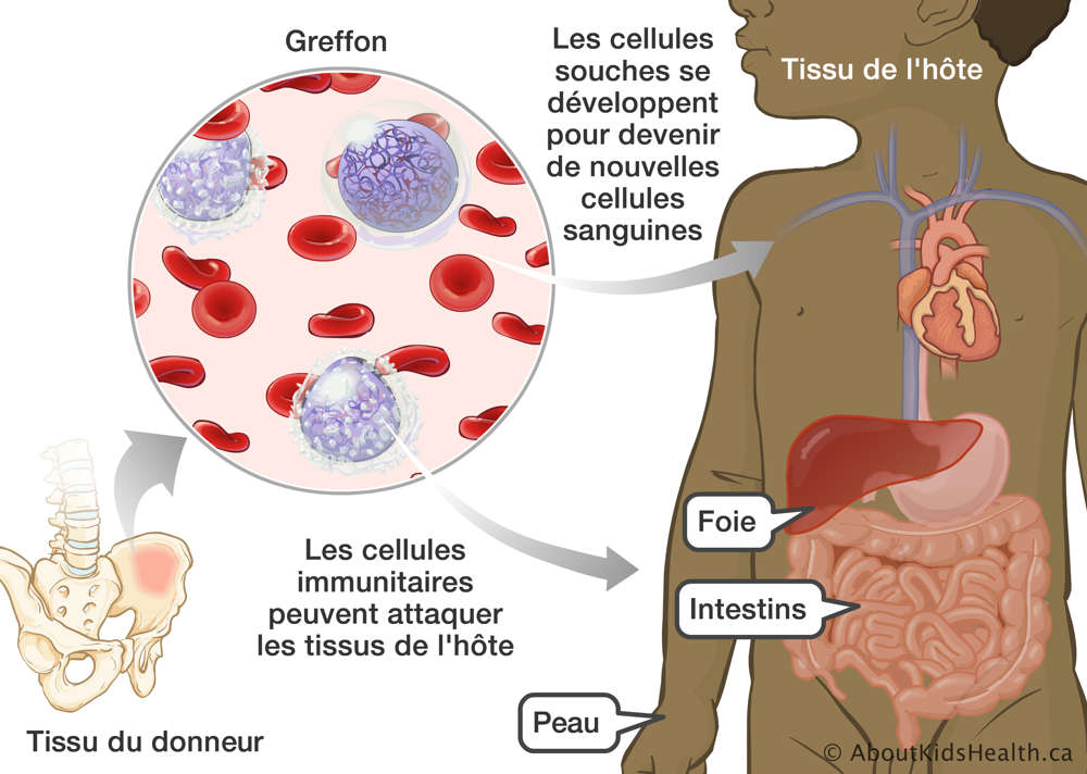 Des cellules souches devenant de nouvelles cellules sanguines et des cellules immunitaires attaquant les tissus de l’hôte