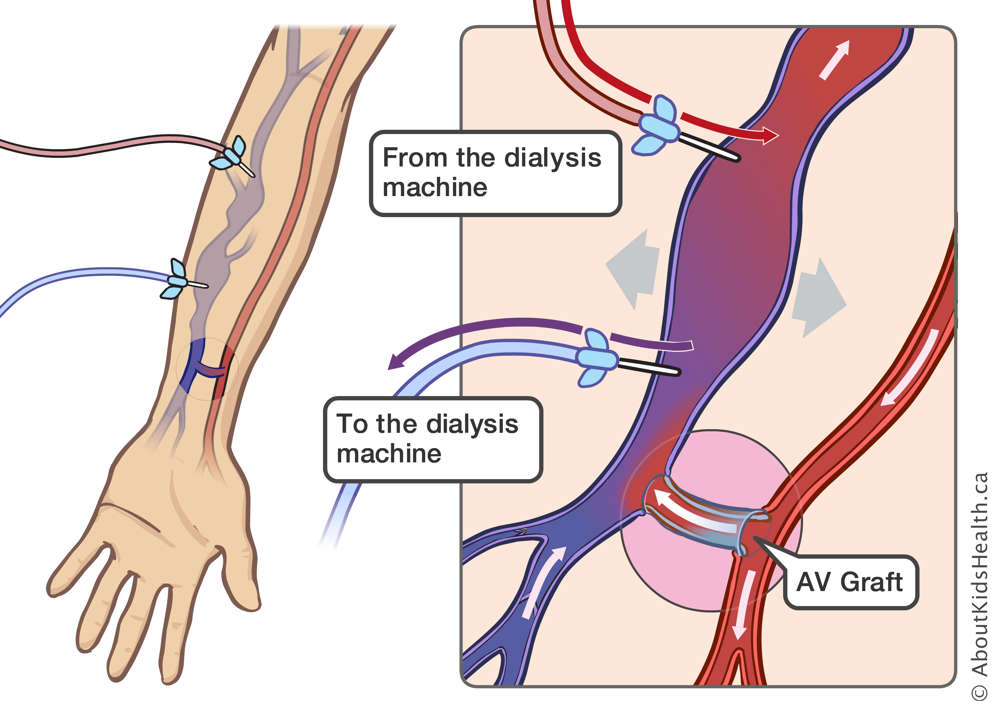 An AV graft attached to a vein and two needles inserted into the vein allowing blood to pass to and from the dialysis machine