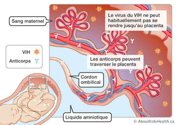 Le virus du VIH dans le placenta et les anticorps dans le placenta, le cordon ombilical et le bébé