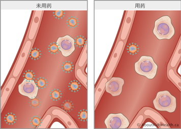 未用药情况下,血液中有若干HIV细胞;用药后,血液中仅有一个HIV细胞