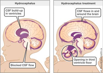 Side-by-side view of hydrocephalus and ETV surgery, which creates an opening in the third ventricle
