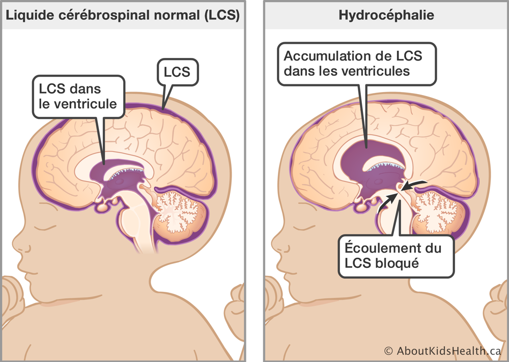 Bébé avec liquide cérébrospinal normal (LCS) autour du cerveau et bébé avec accumulation de LCS dans les ventricules