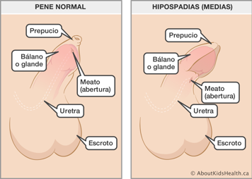 Identificación del meato (abertura), prepucio, glande, uretra y escroto en un pene normal y en un pene con el hipospadias