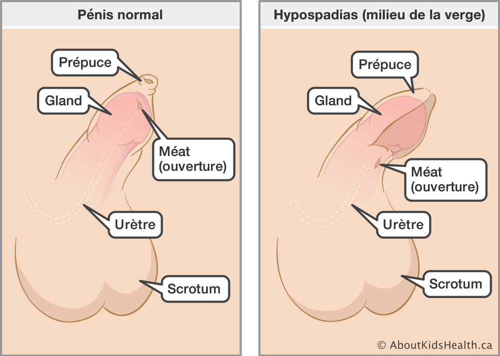 L’emplacement du prépuce, du gland, du méat, de l’urètre et du scrotum dans un pénis normal et dans un pénis avec hypospadias