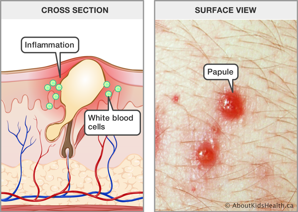 Cross section of skin with inflammation and white blood cells around sebum, and surface view of skin with papules