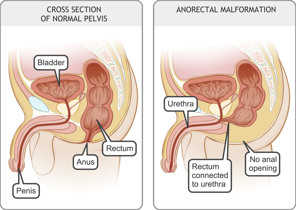 Cross-section of normal pelvis in a boy and cross-section of pelvis with rectum connected to urethra and no anal opening