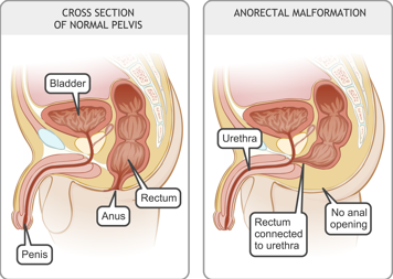Cross-section of normal pelvis in a boy and cross-section of pelvis with rectum connected to urethra and no anal opening