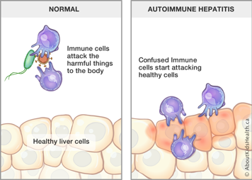 Immune cells attacking harmful things in normal body and confused immune cells attacking liver cells in autoimmune hepatitis