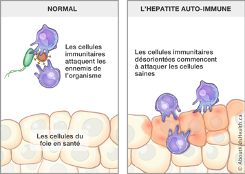 Cellules imminutaires attaquant les ennemis du corps et des cellules immunitaires désorientées attaquant les cellules saines