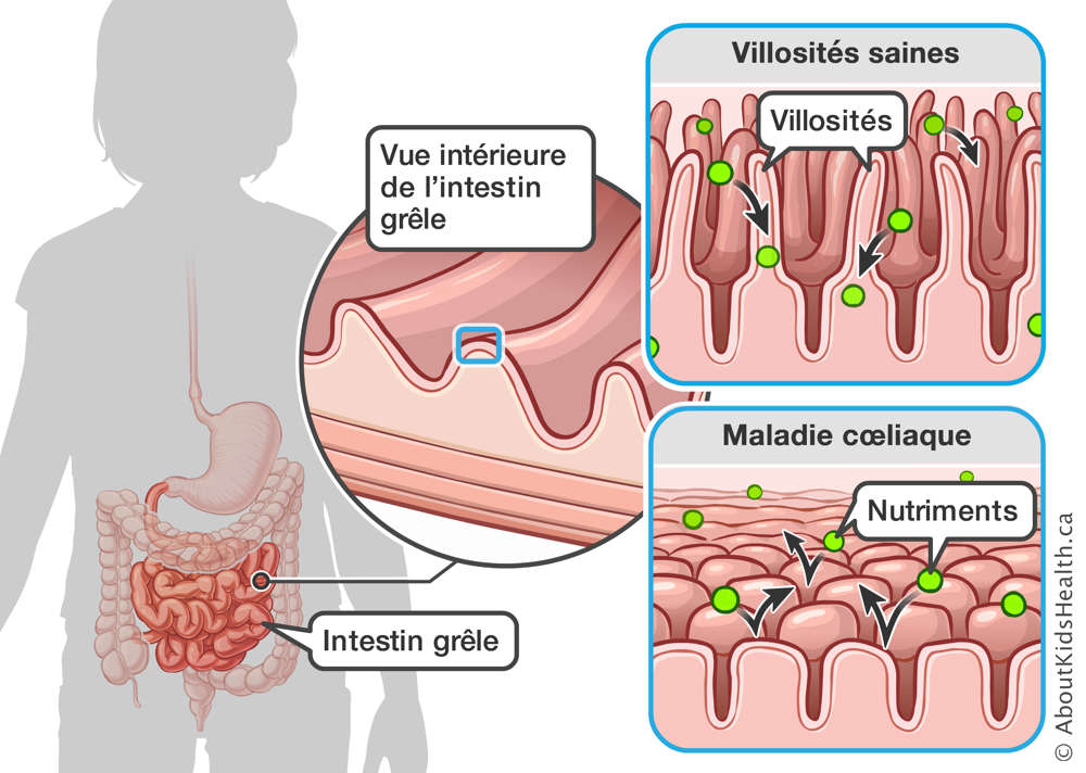 Vue intérieure de l’intestin grêle, montrant l’absorption des nutriments avec villosités saines et avec maladie cœliaque