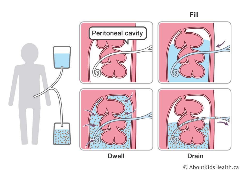 Medical illustration of catheter in peritoneal cavity, which fills the cavity with solution, and then the solution is drained