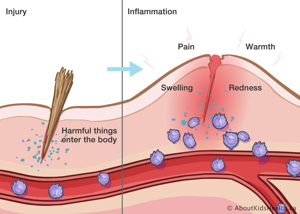 Splinter in the skin causing pain, warmth, redness and swelling