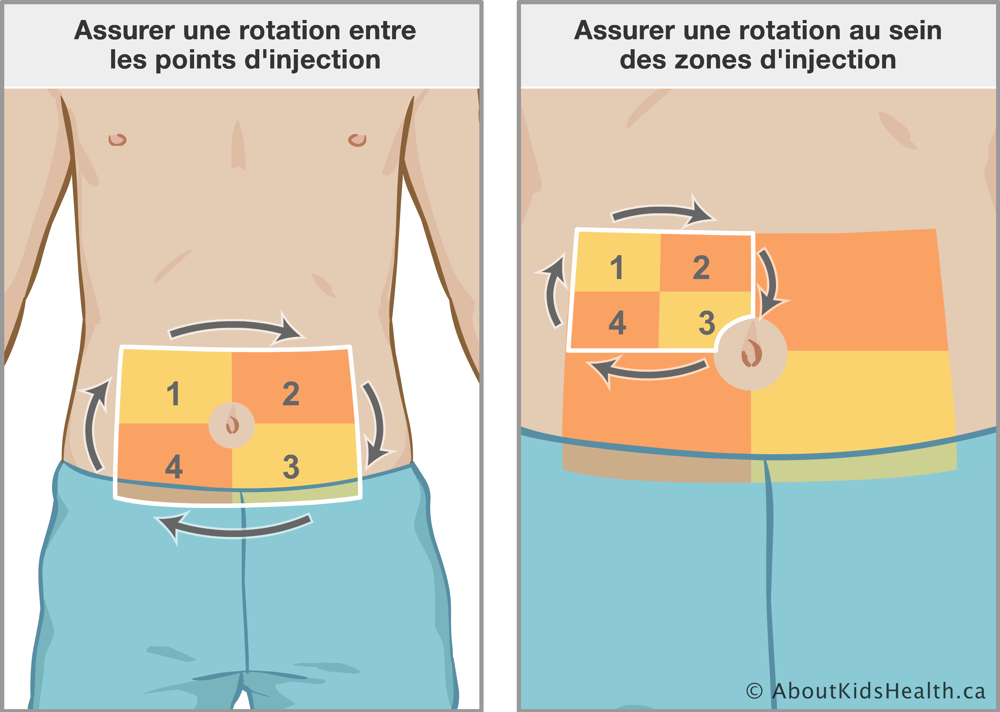 Assurer une rotation entre les quatre points d’injection sur l’abdomen et puis une rotation au sein des zones d’injection