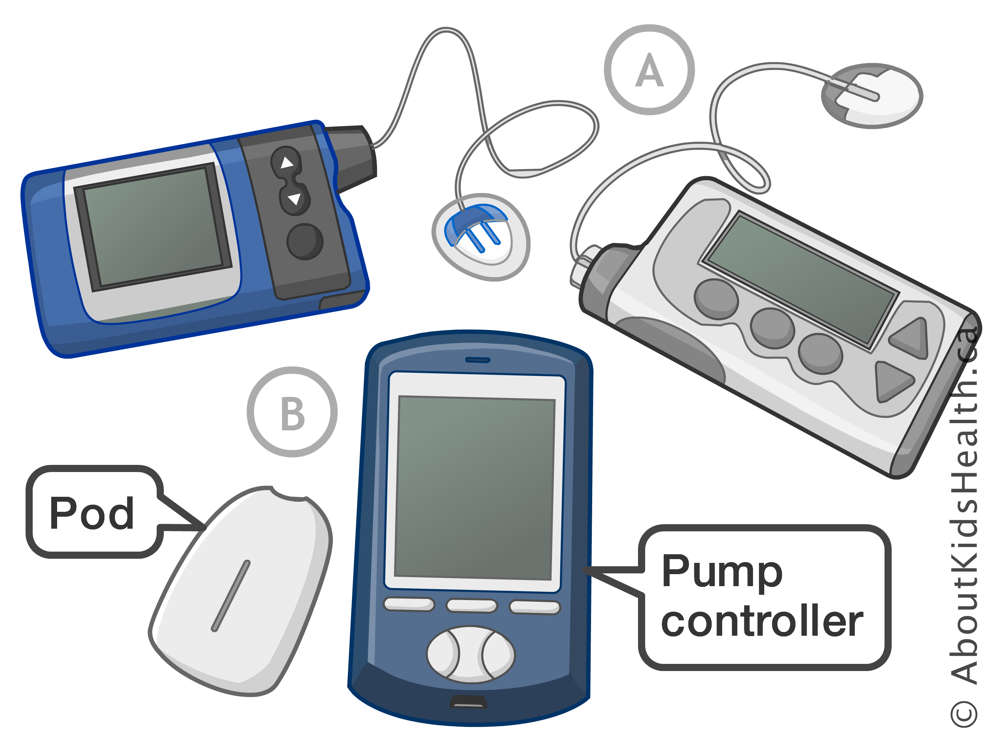 Insulin pumps with plastic tubing and an insulin pump without tubing, but with a pod and pump controller