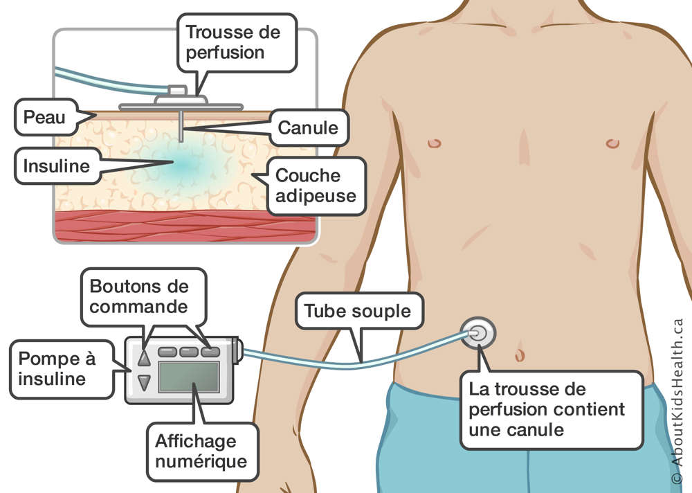 Une pompe à insuline avec boutons de commande, affichage numérique, tube souple et trousse de perfusion contenant une canule