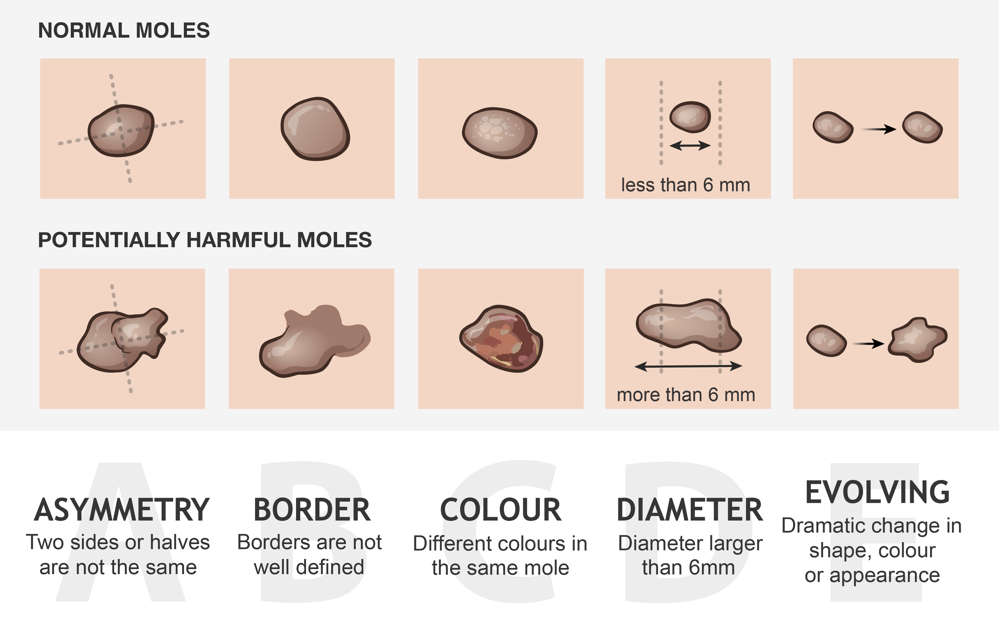 Check moles for asymmetry, undefined borders, different colours, diameter larger than 6mm, and evolving appearance