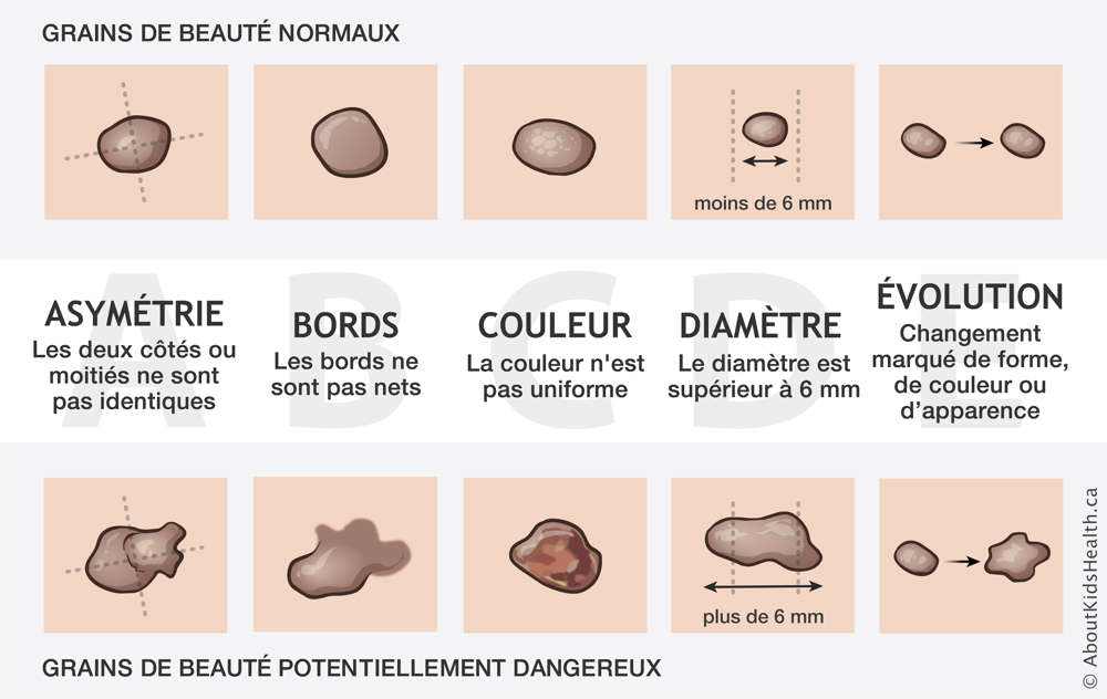 Illustration des grains de beauté normaux et des grains de beauté potentiellement dangereux selon la règle de l’ABCDE
