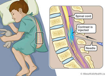 Needle injecting contrast into child’s spinal canal