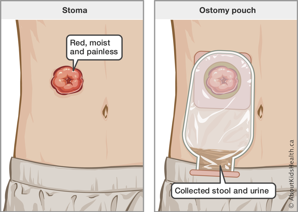 Abdomen with a red, moist and painless stoma and an abdomen with an ostomy pouch over stoma collecting stool and urine