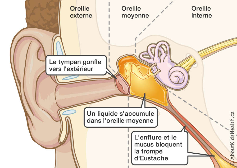 Un tympan gonfl&eacute; &agrave; cause de l'enflure et des blocages dans la trompe d'Eustache