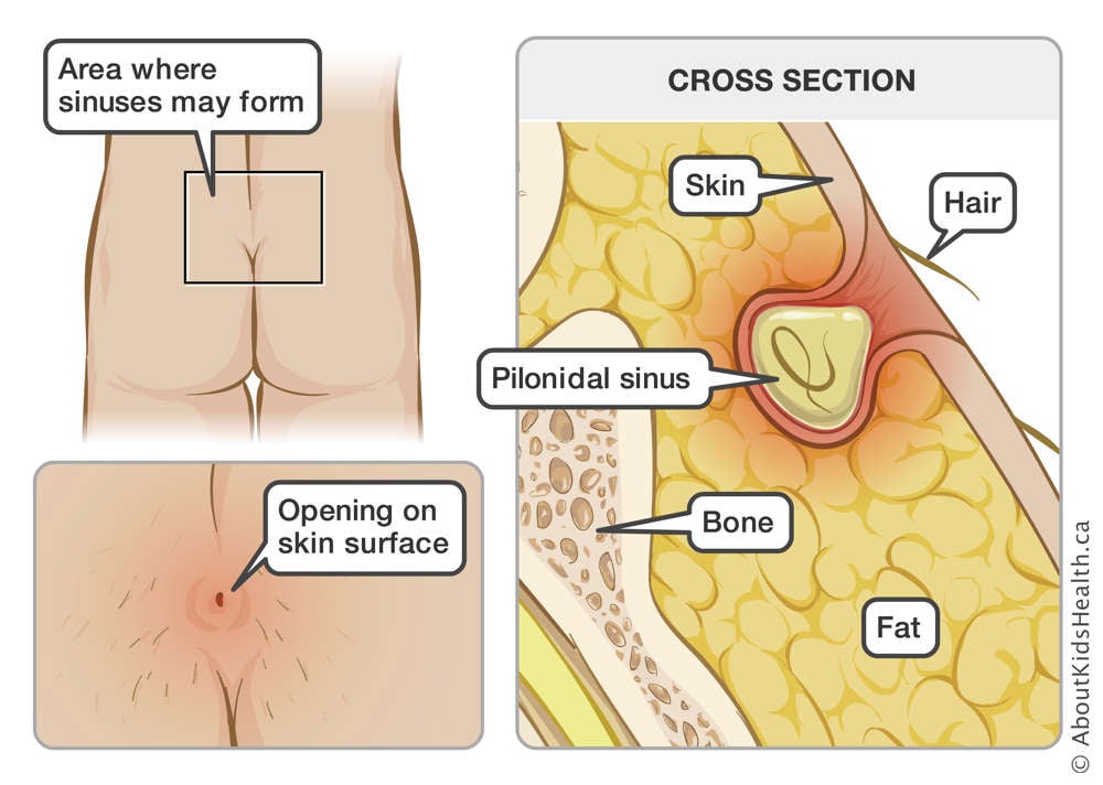 Buttocks with area where sinuses may form identified and a cross section locating hair, skin, pilonidal sinus, bone and fat