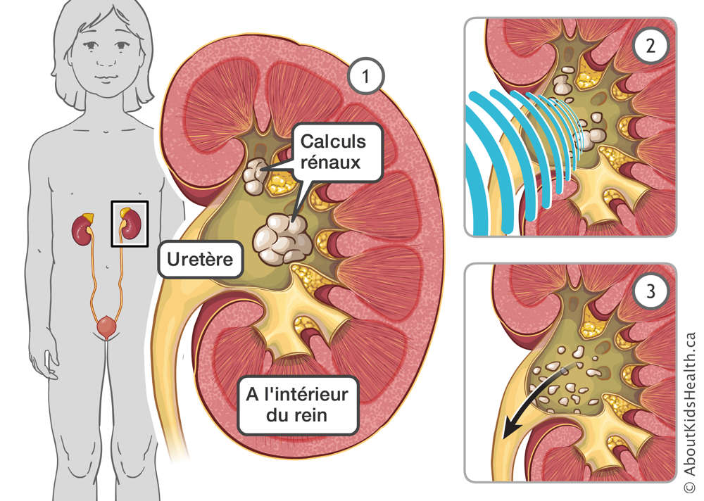 Illustration des calculs rénaux dans le rein pendant la lithotritie par ondes de choc