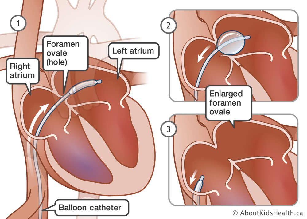 A balloon catheter inserted through the foramen ovale between the right and left atriums of the heart