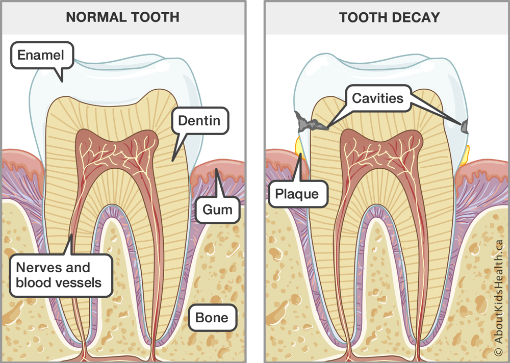 Illustration of the anatomy of a normal tooth and a tooth with decay