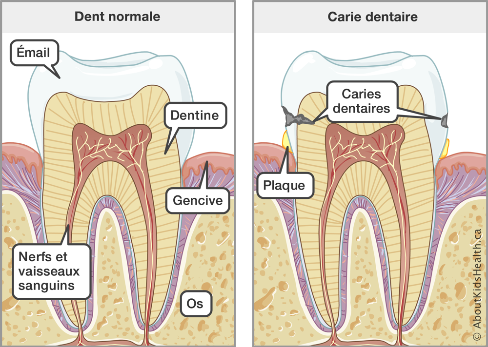 Illustration de l’anatomie d’une dent normale et d’une dent avec carie dentaire