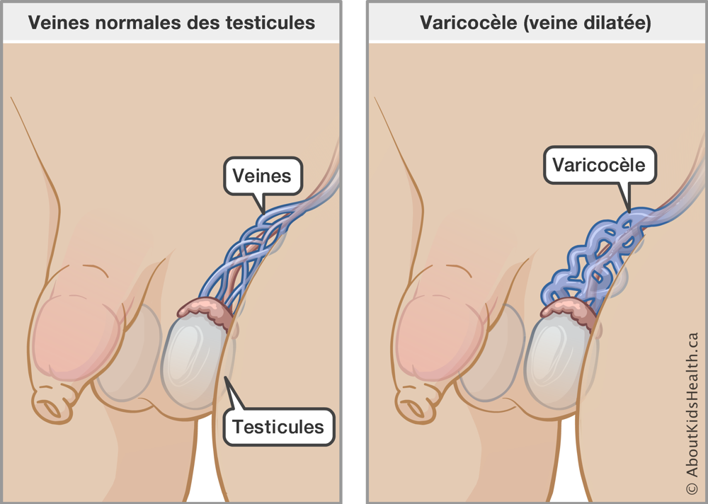 Illustration des veines normales des testicules et de varicocèle (veine dilatée)