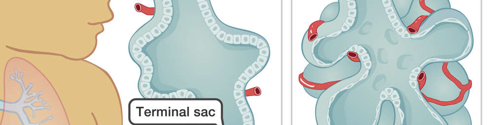 Medical illustration of immature lungs with blood vessels away from walls of terminal sac. Mature lung has mature alveolus with blood vessels wrapped around.
