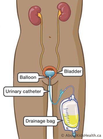 Urinary catheter with drainage bag inserted into female bladder