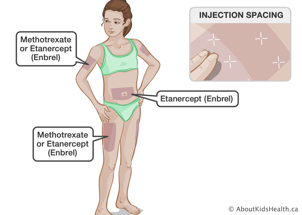 Identification of injection sites of methotrexate and etanercept on a girl’s body