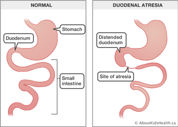 Medical illustration of normal gi tract beside a gi tract with narrowing of the small intestine just below distended duodenum